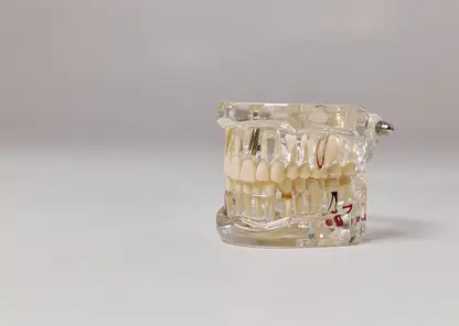 Бразильские имплантаты Riellen’s: путь к идеальной улыбке за один день